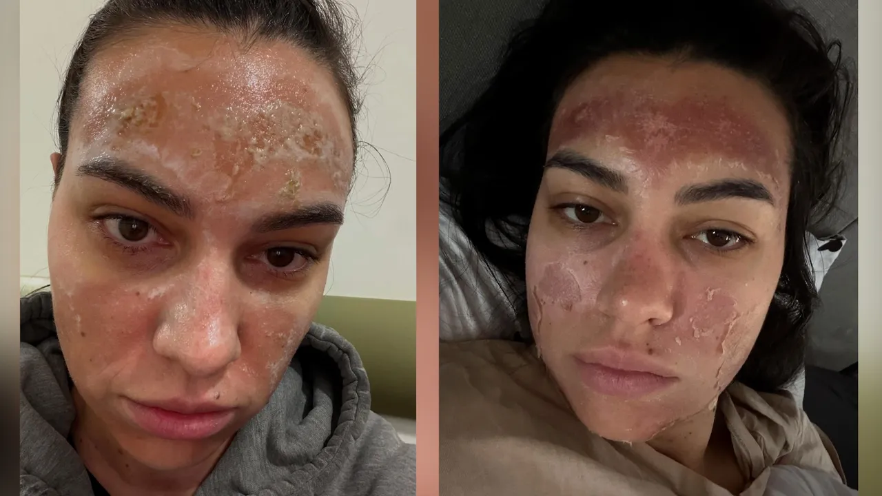 Кръв, сълзи и изгаряния втора степен: Билков пилинг изгори лицето на млада жена