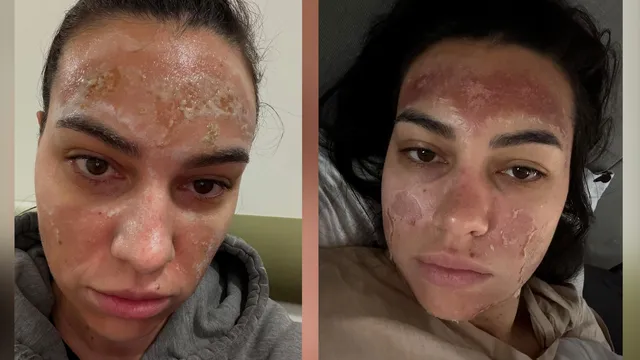 Кръв, сълзи и изгаряния втора степен: Билков пилинг изгори лицето на млада жена