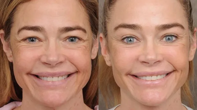 Денис Ричардс - откровено за фейс лифта