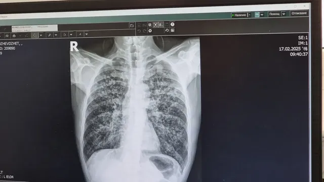 Безплатни консултации за туберкулоза в столицата до 27 март